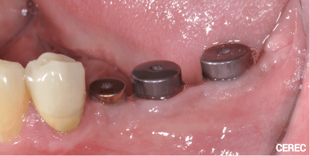 Kronen auf Implantaten